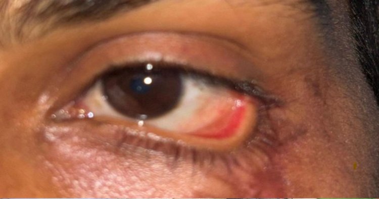 स्किन ग्राफ्टिंग से मरीज के पलक का सफल पुनर्निर्माण